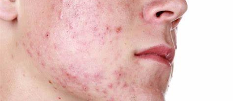 Acne Treatment Using Roaccutane Pills (Isotretinoin) and its Side Effects